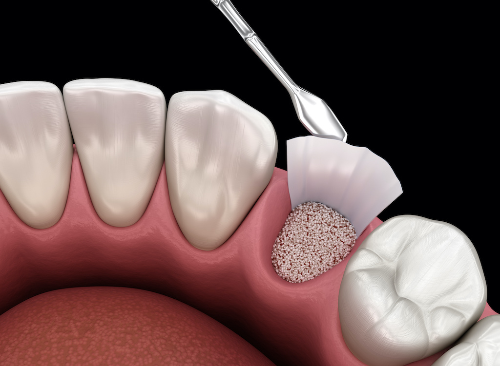 Dental bone grafting